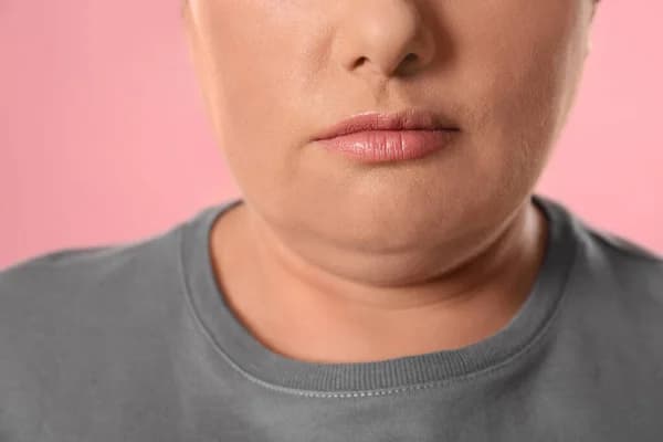What is Double Chin Surgery? 