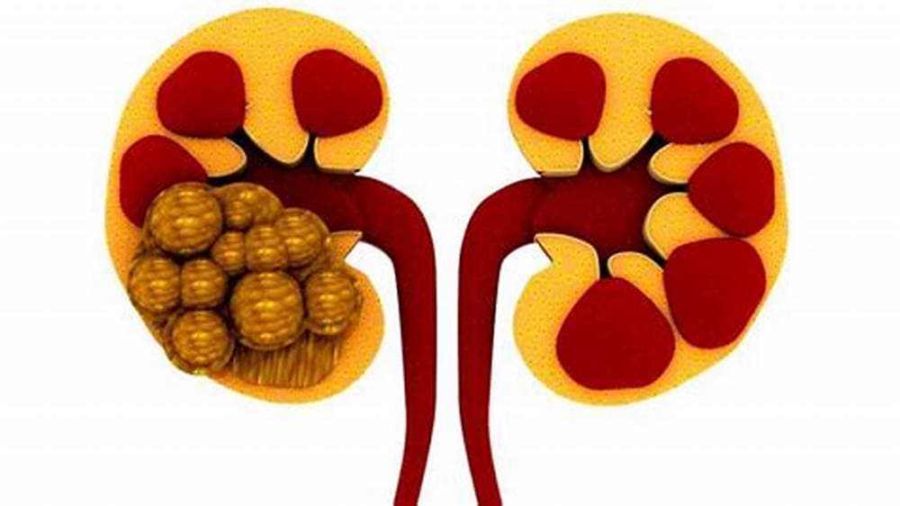 What is a kidney stone? 
