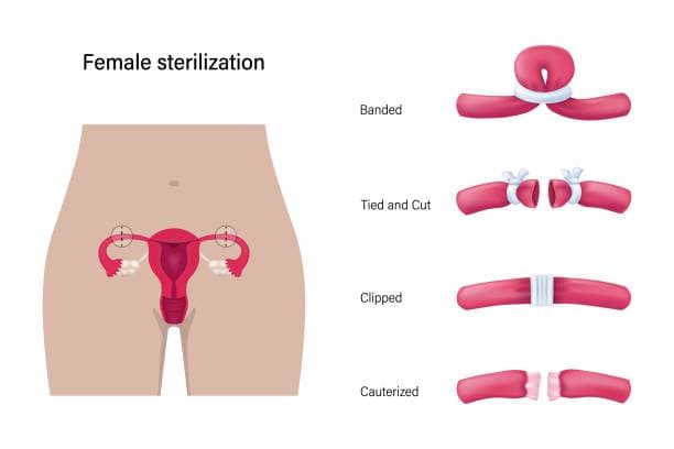 Tubal Ligation procedures