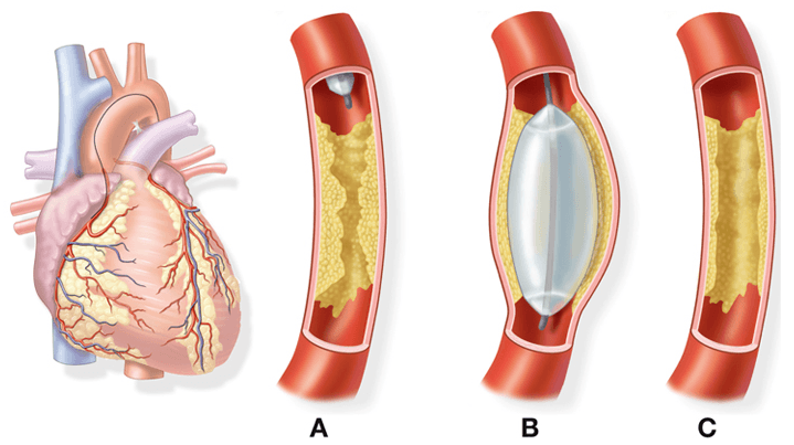 Angiography procedure