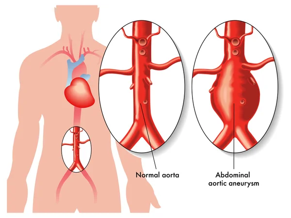 Aortic Surgery survival rates