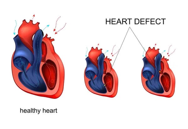 Congenital heart defect repair recovery
