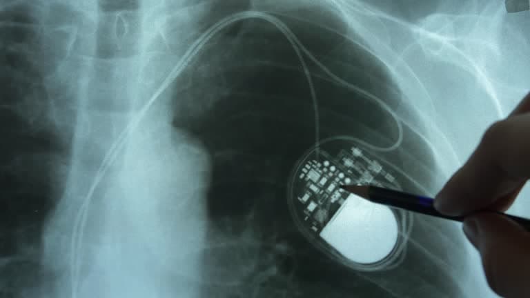 Is Pacemaker placement a major surgery?