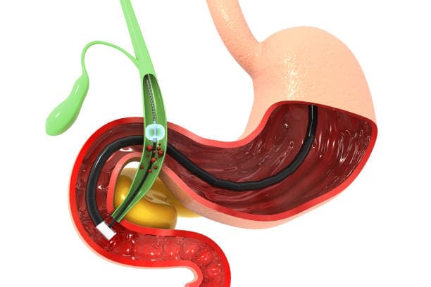 Why is Cholecystectomy done?