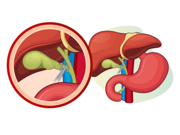 Cholecystectomy cost in Iran