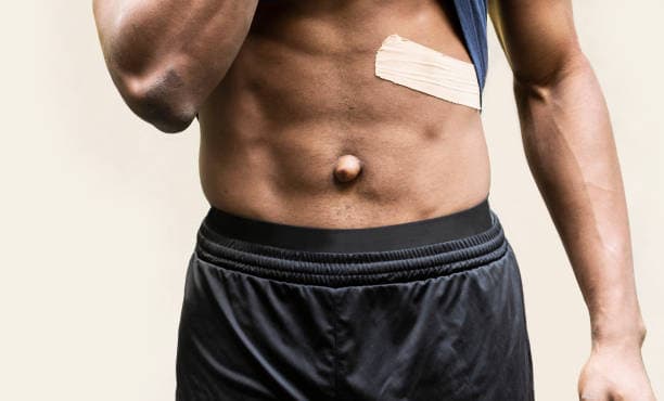 What is a Hernia surgery?