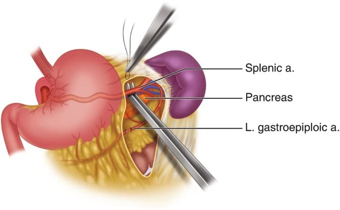 Splenectomy cost in Iran