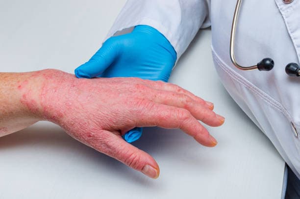 Who does eczema affect?