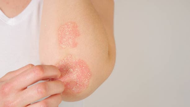 What are the symptoms of eczema?