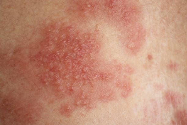 How to prevent Eczema