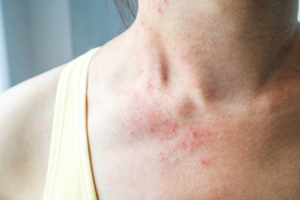 Eczema Treatment cost in Iran