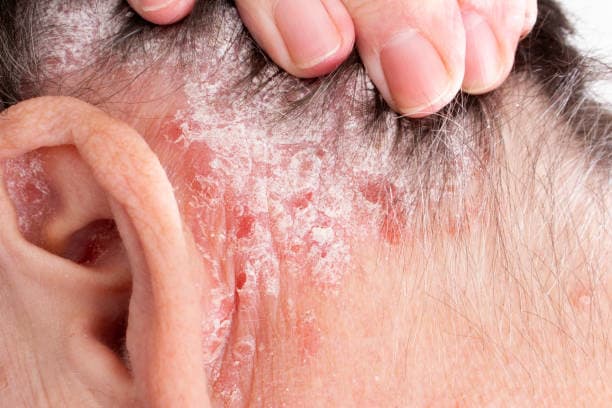 Psoriasis Treatment 