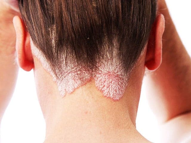 What are the types of psoriasis?