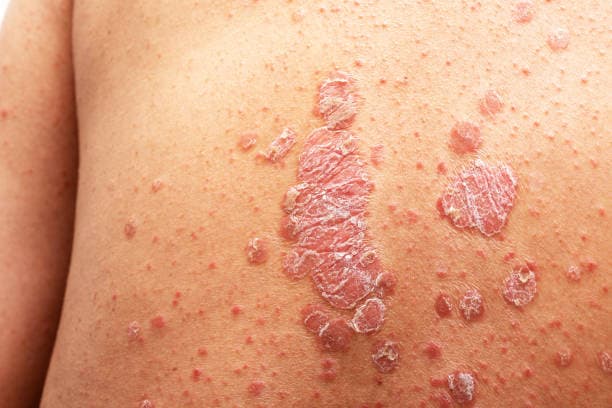 How is psoriasis diagnosed?