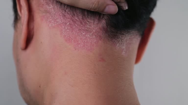 Psoriasis complications