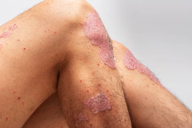 How to prevent psoriasis