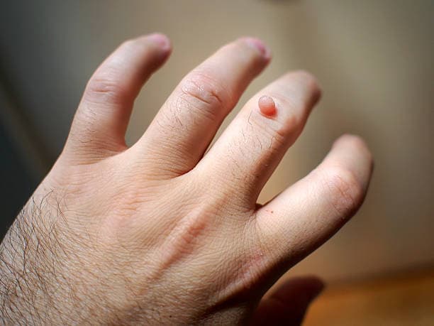 What are the symptoms of Warts?