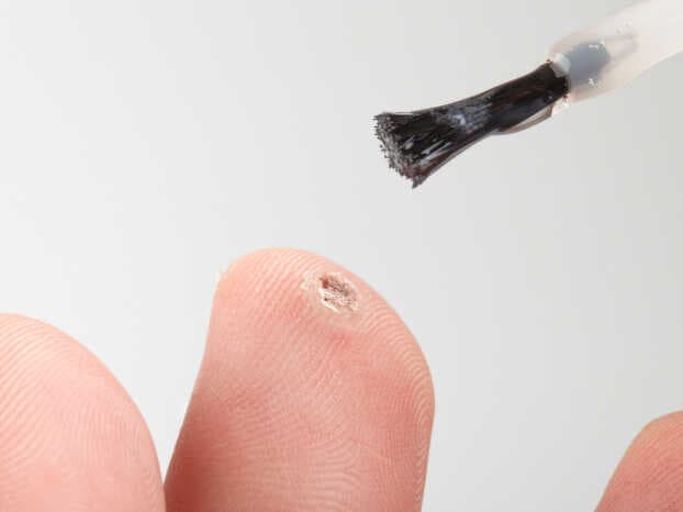 How are Warts diagnosed?