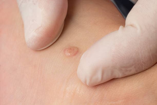 How to prevent Warts