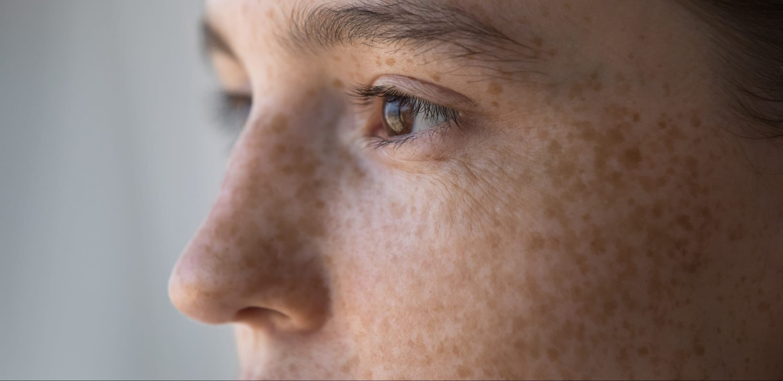 Melasma Treatment