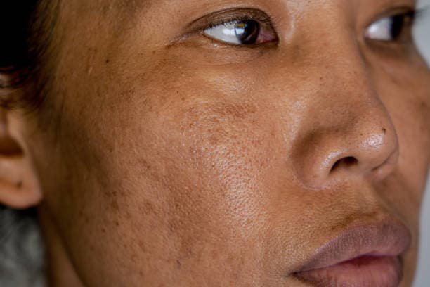 Melasma medication complications