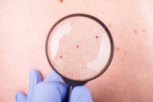Can hemangiomas be removed?