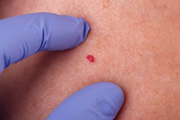 Hemangioma Treatment cost in Iran