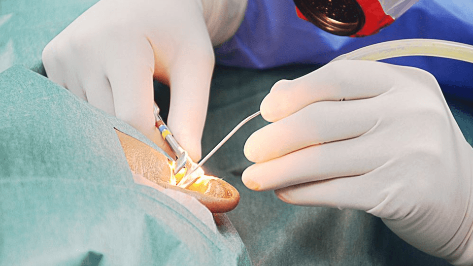 Why is mastoidectomy performed?