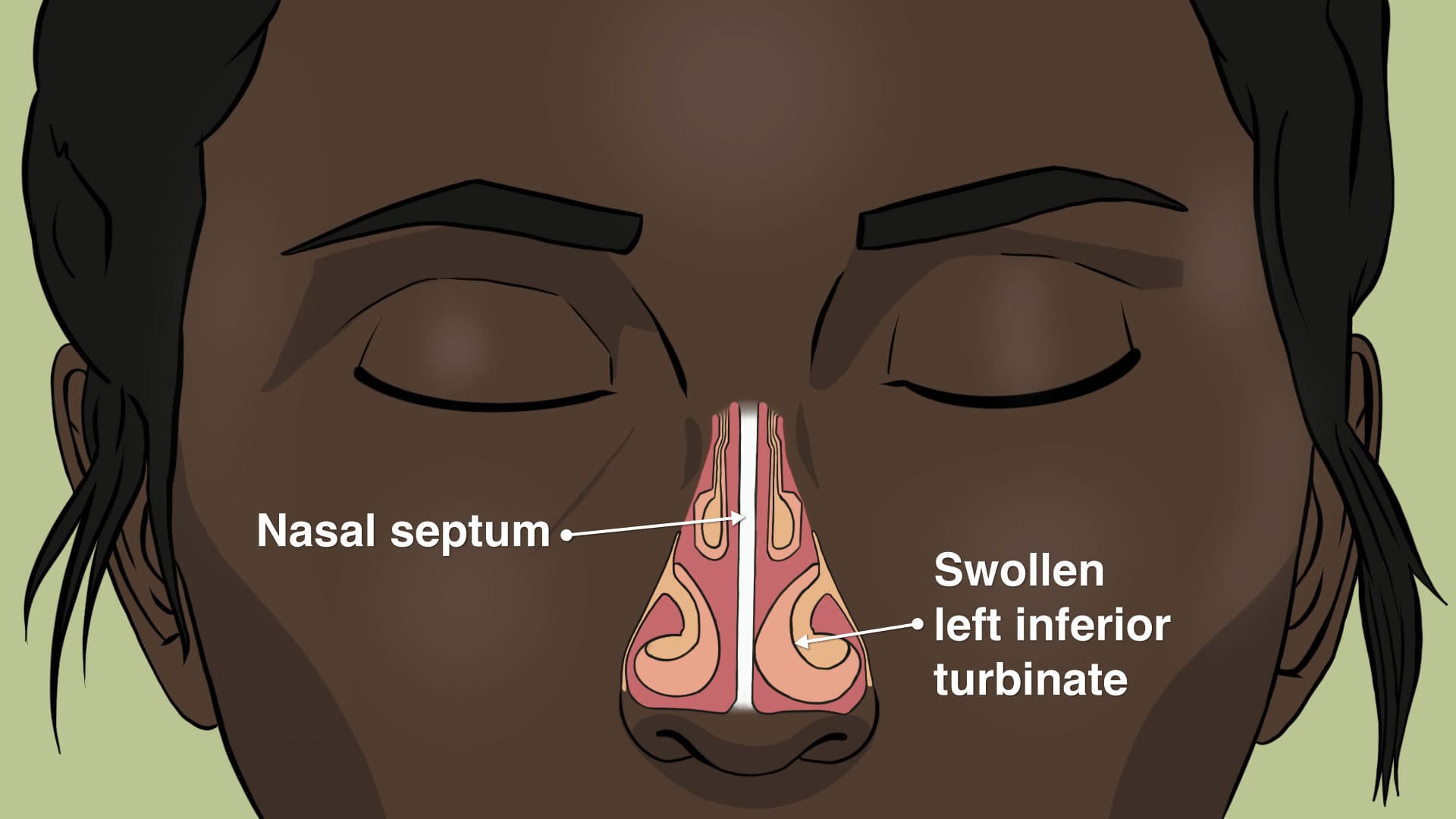 What happens during Turbinoplasty surgery?