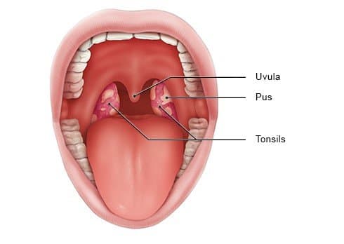 What happens during a Tonsillectomy?