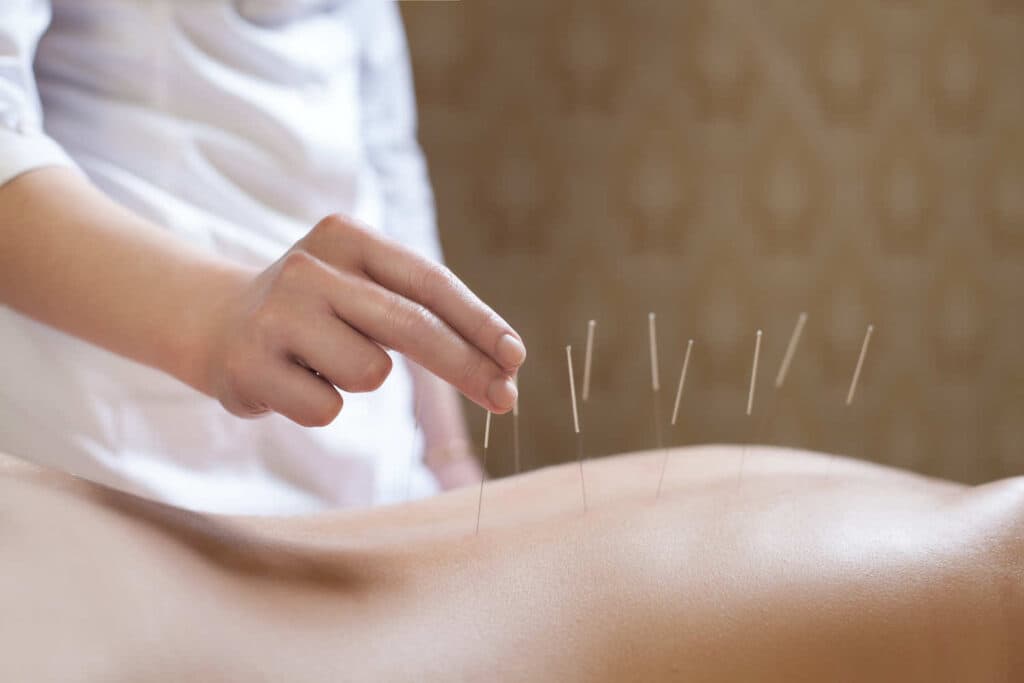What is acupuncture?