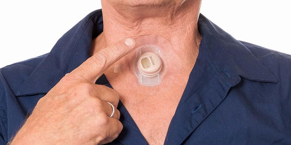 Types of Laryngectomy