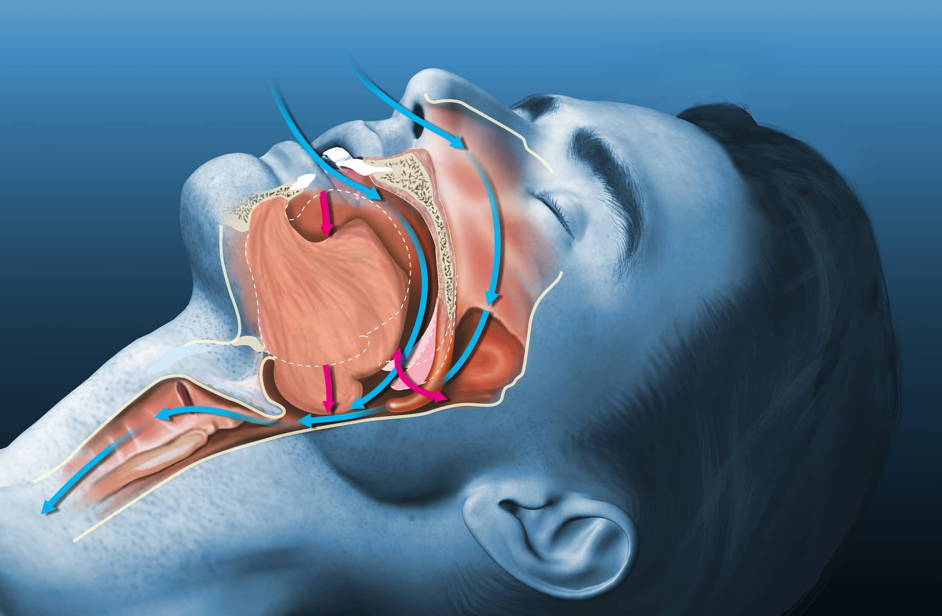 What is uvulopalatopharyngoplasty (UPPP surgery)?