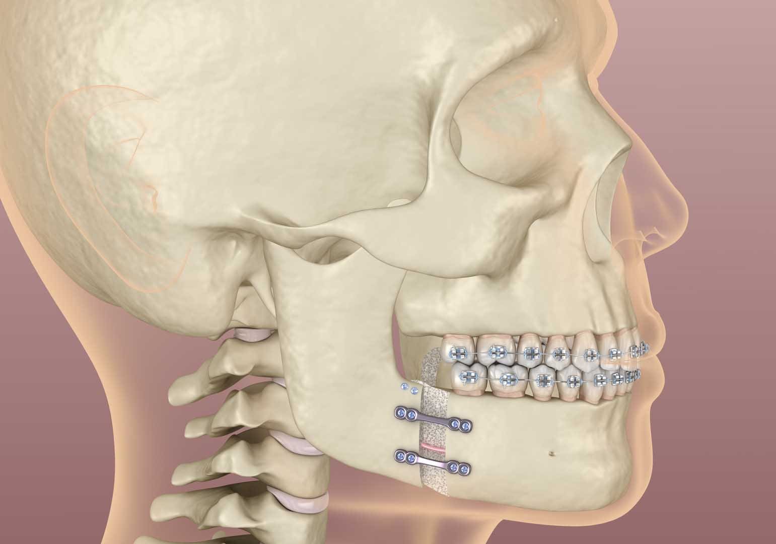 Jaw Surgery 