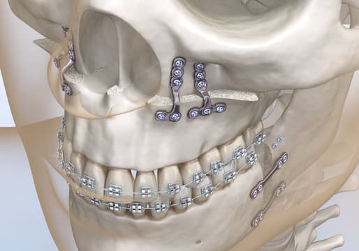 Types of jaw surgery