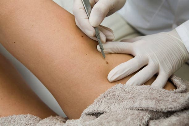 Why is mole removal done?