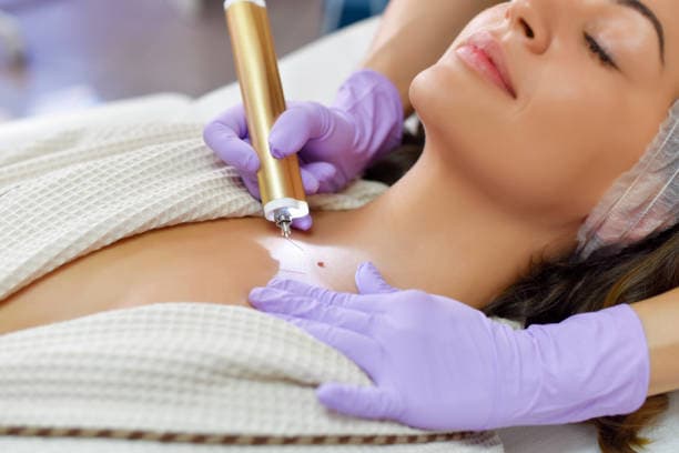 What happens before Mole Removal?