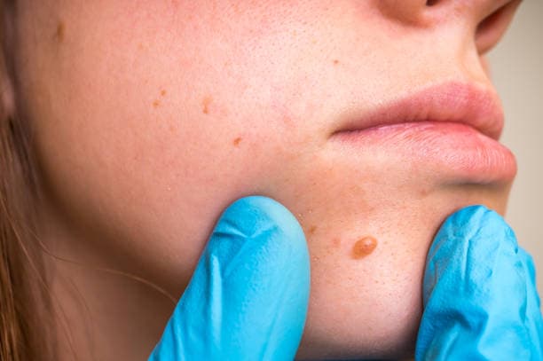 Mole Removal risks & benefits
