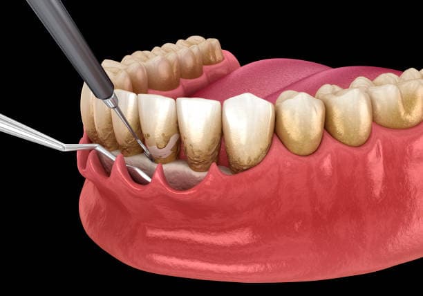What is periodontal disease?