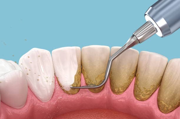 What are the causes & risk factors of periodontal disease?
