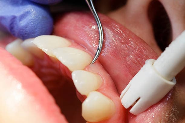 How to prevent periodontal disease?