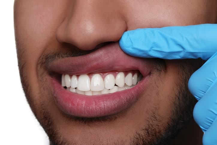 Periodontal (Gum) treatment cost in Iran