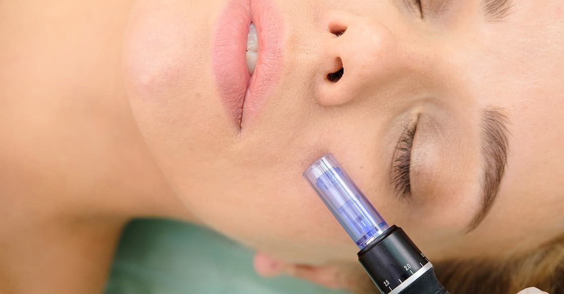 What is microneedling?