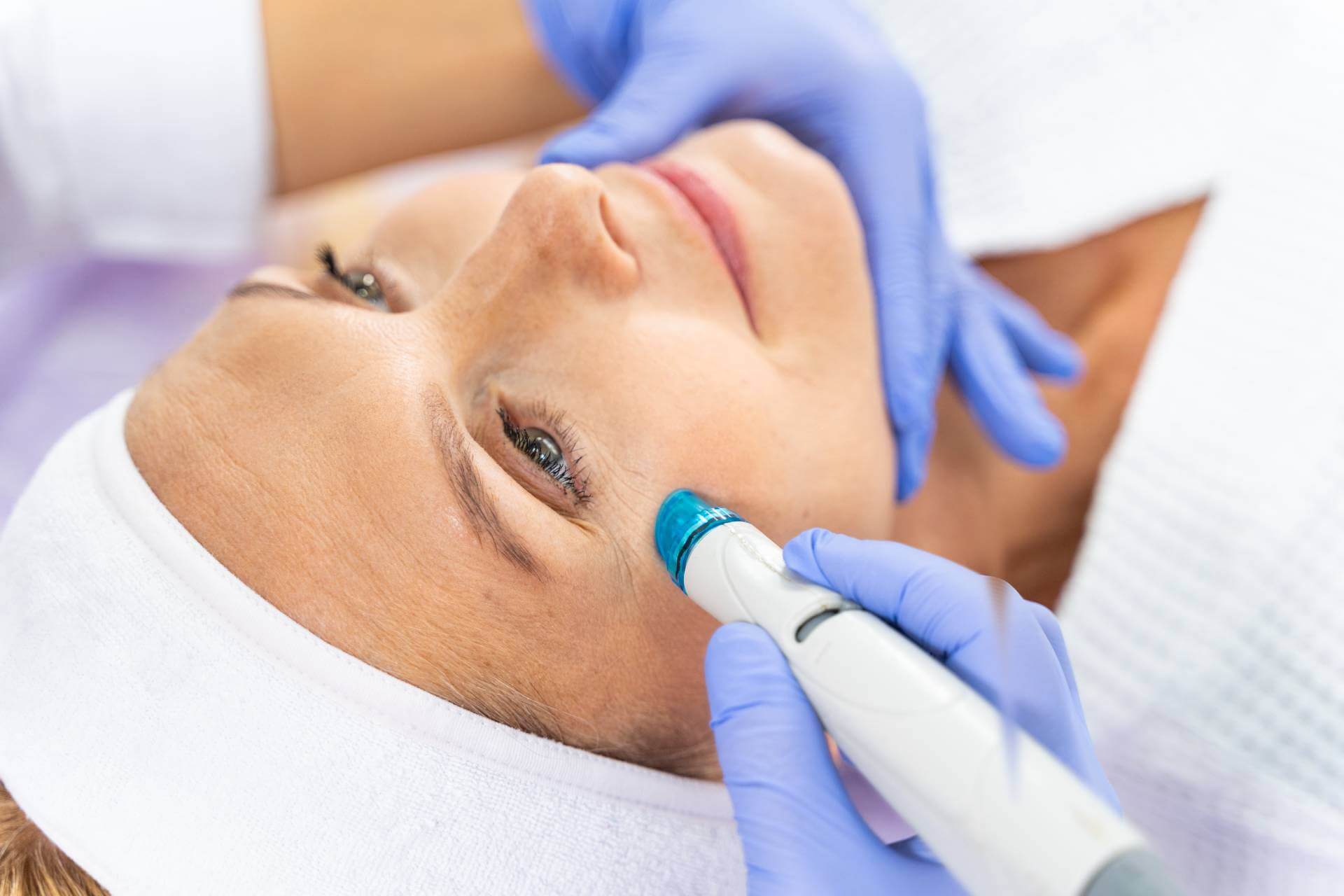 Who gets microneedling?