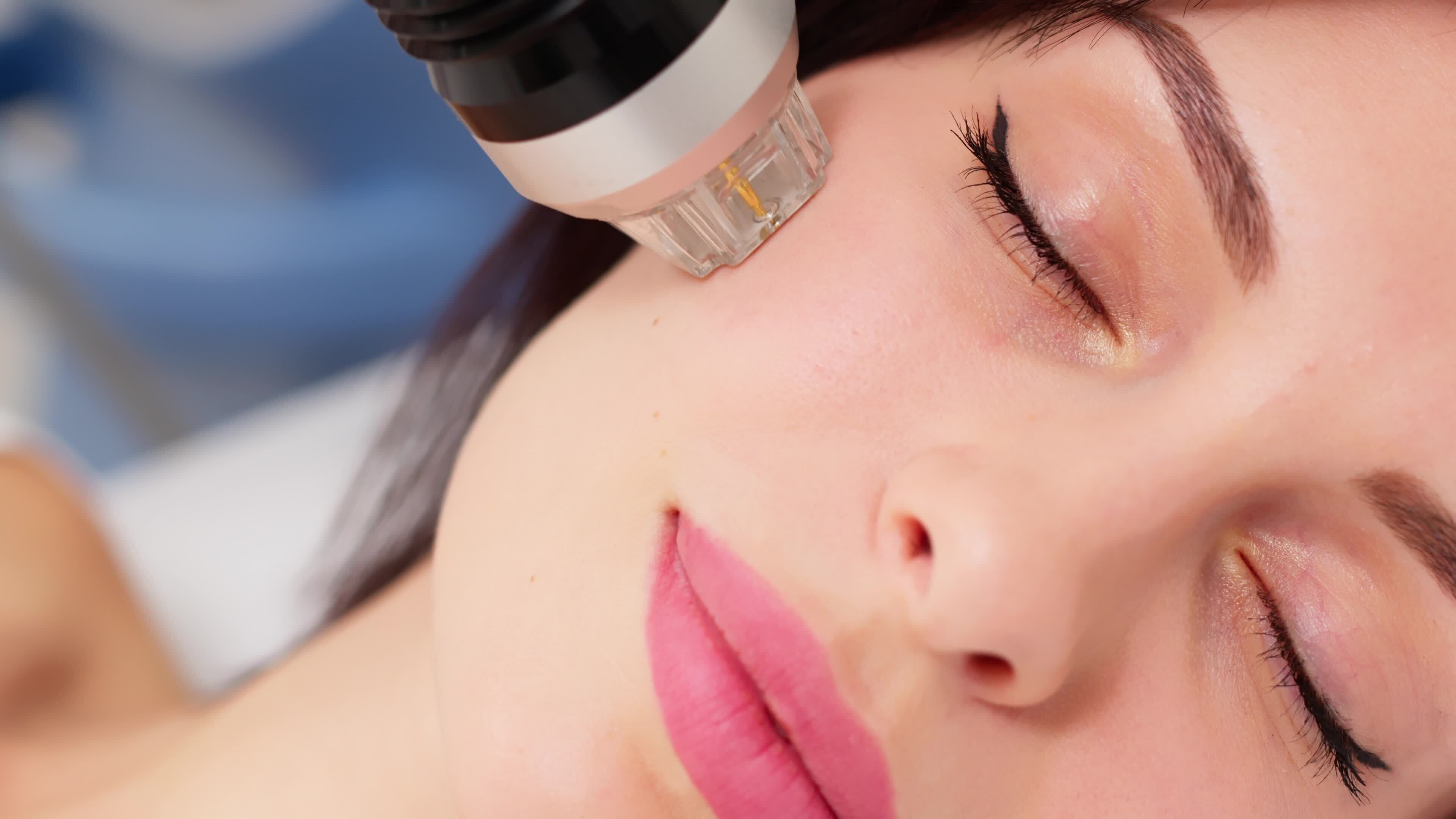 What happens during microneedling?