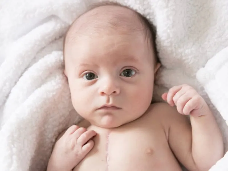 What is a single ventricle heart defect?