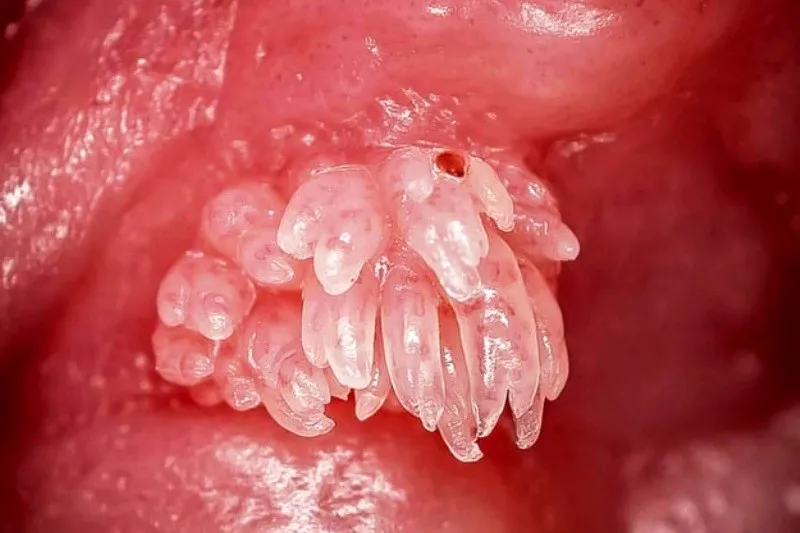 Diagnosis of Human Papillomavirus (HPV) cost in Iran