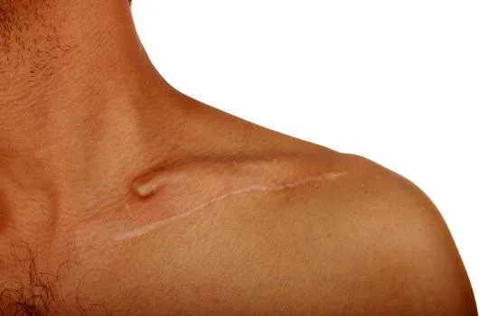 What is Scar Removal Surgery? 