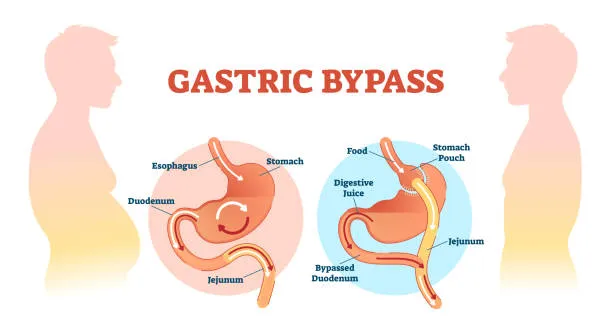 Gastric Bypass Cost in Iran 