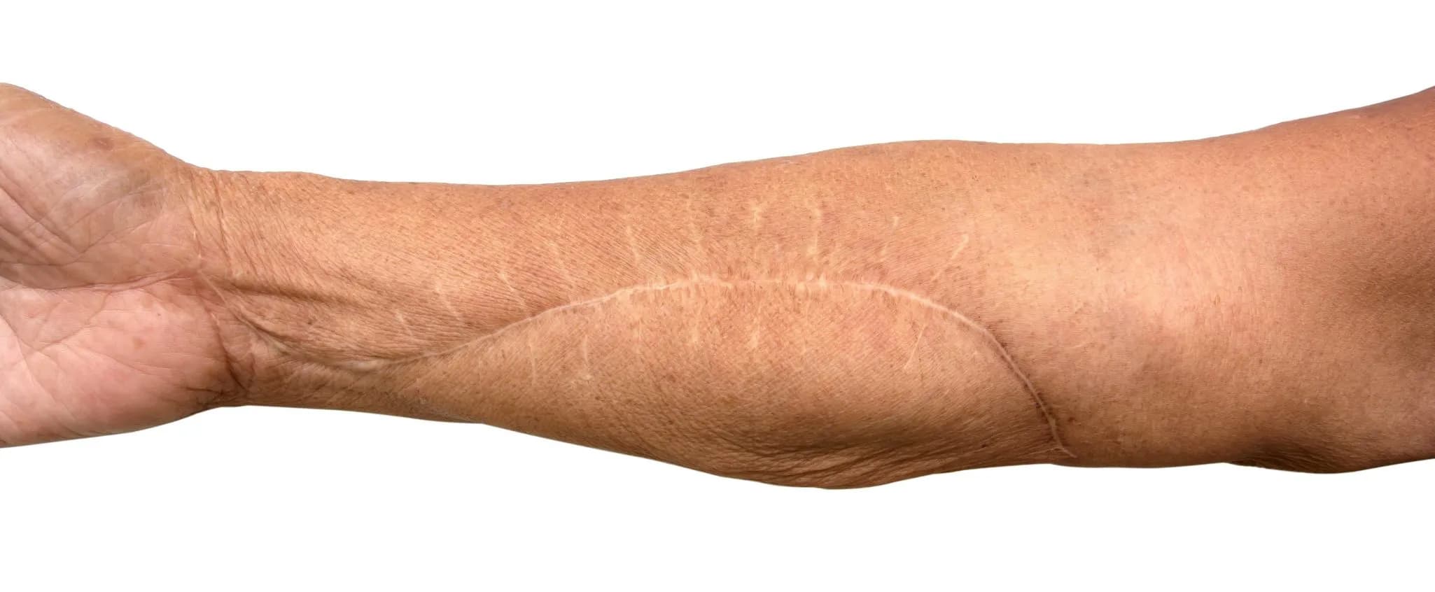 Scar Removal Cost in Iran